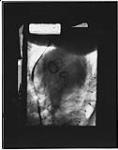 X-Ray photograph of artificial valves in a human heart 1965