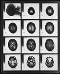Computerized axial tomography (CAT) scan, an e-ray technique, used here to produce a series of cross-sectional views of a human head, at those places indicated in the upper-left photo 1986