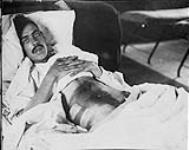 World War I soldier (probably Canadian) with penetrating wound of abdomen 1917