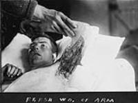 World War I soldier (probably Canadian) in hospital bed, showing flesh wound of arm 1917