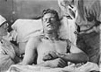 Unidentified Canadian soldier with burns caused by mustard gas ca. 1916 - 1918