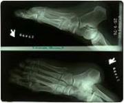 X-rays of Veronica Tennant's feet [graphic material] September 25, 1976.